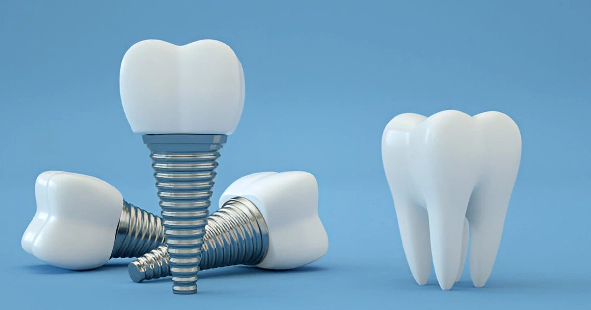 Are dental crowns permanent