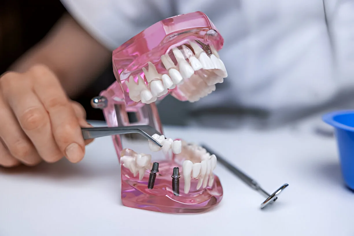 How Long Can a Dental Implant Last