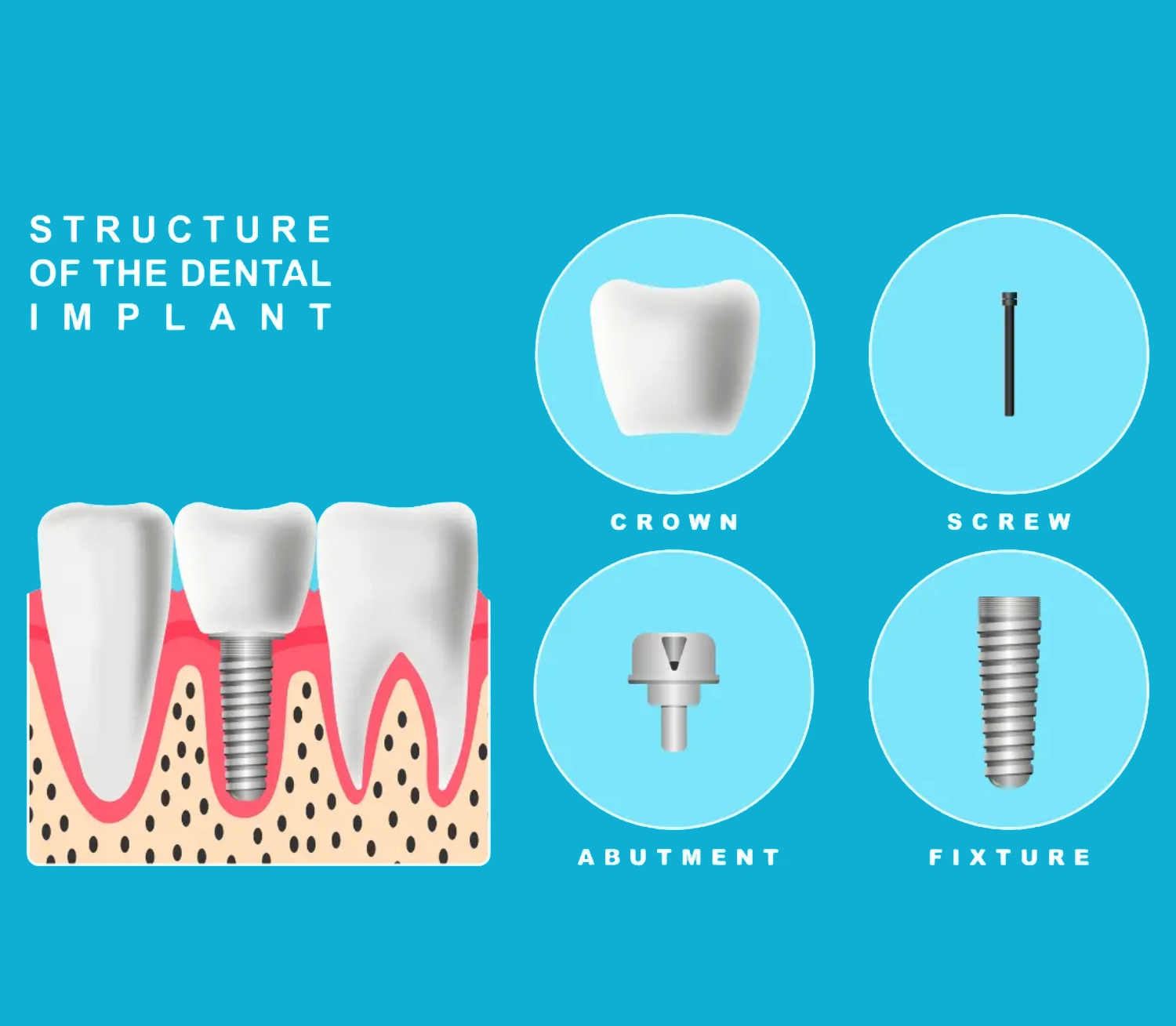 Dental restoration with implants in Newark, NJ
