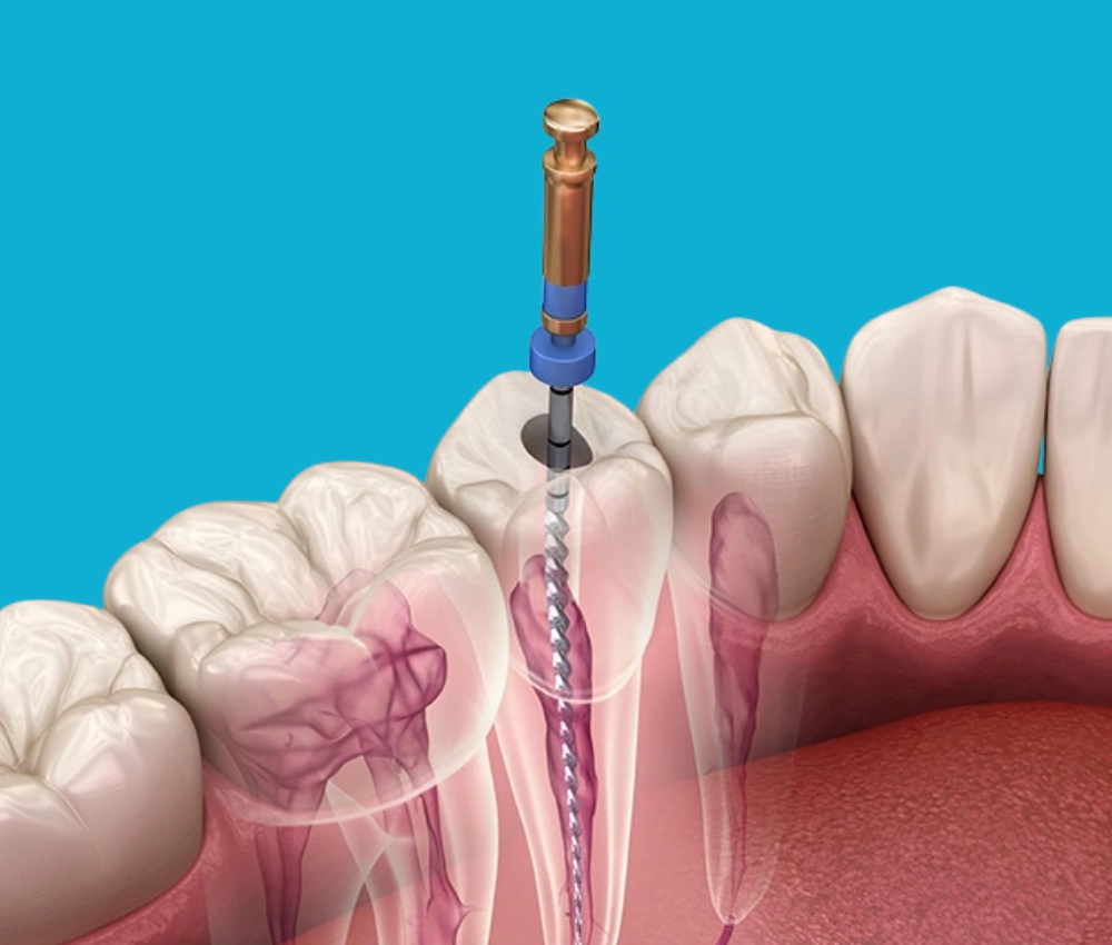 Gentle root canal procedure in Ironbound Newark by Gentle Dental of NJ