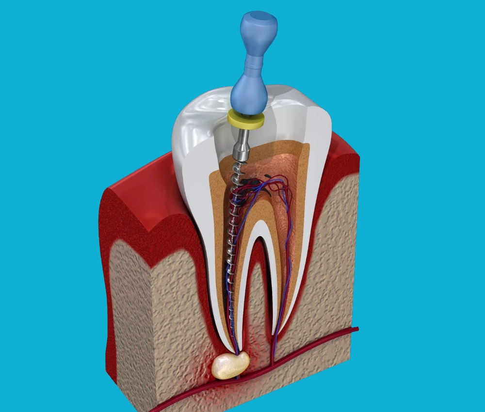 Microscopic endodontics by Newark endodontist, Gentle Dental of NJ
