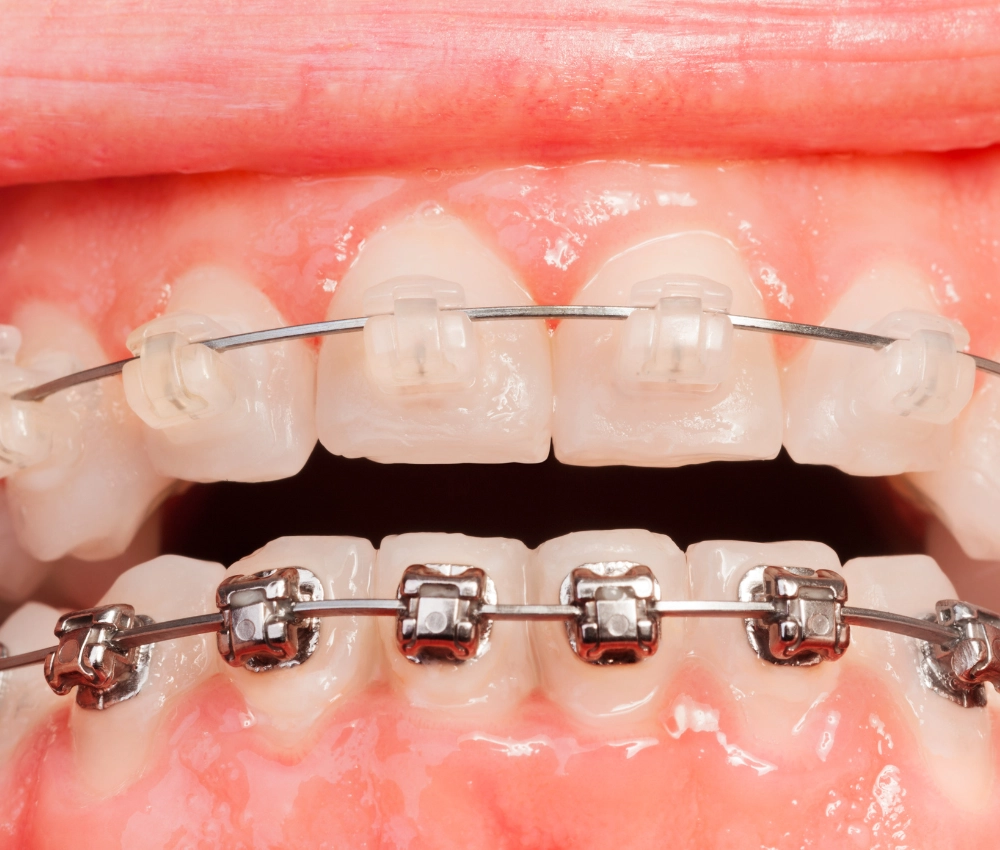 Orthodontic treatment at Gentle Dental of NJ in Newark