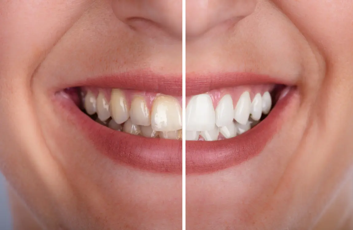 Teeth whitening treatment at Gentle Dental of NJ in Newark