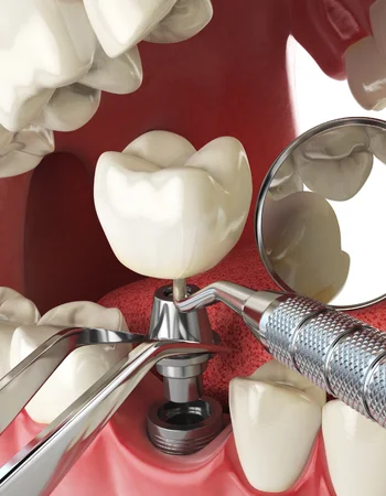Full mouth dental implants Newark NJ