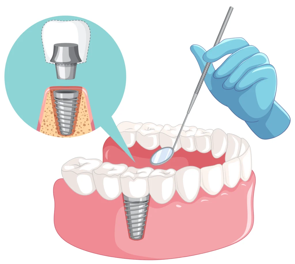 how long do dental implants hurt