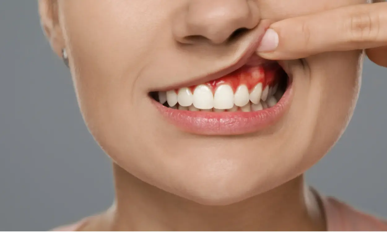 How to Get Rid of Gingivitis