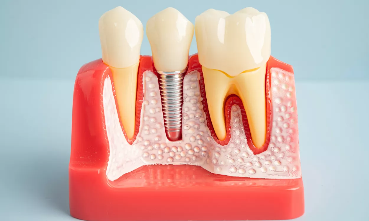 how long does the dental implant procedure take