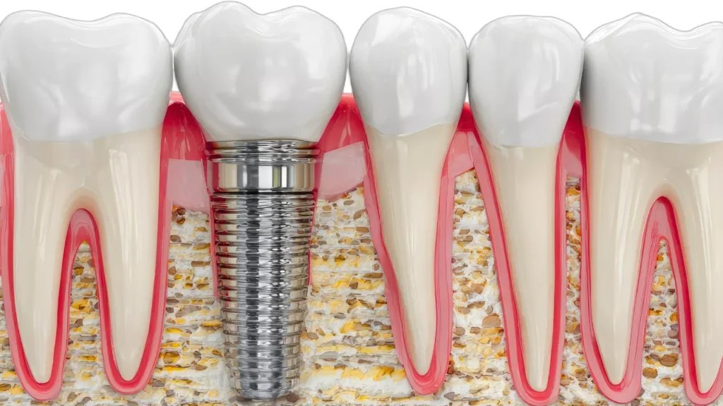Does Dental Insurance Cover Dental Implants