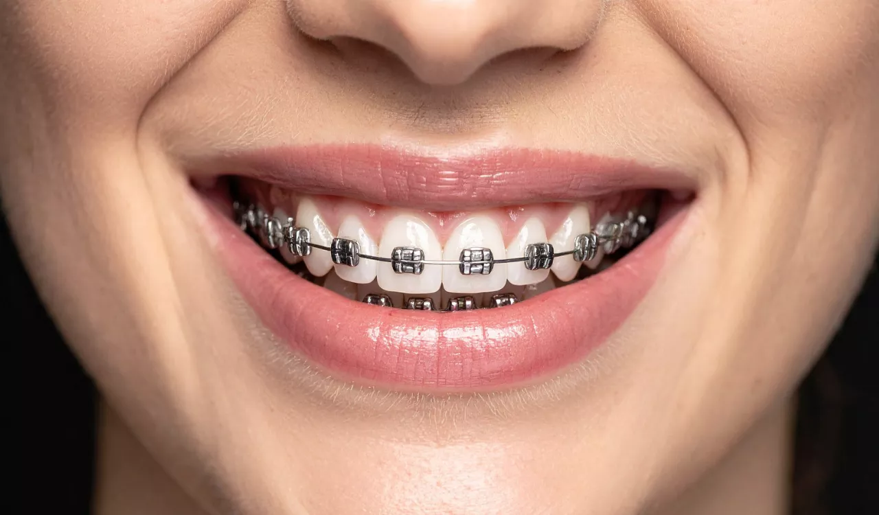 How Much Do Braces Cost
