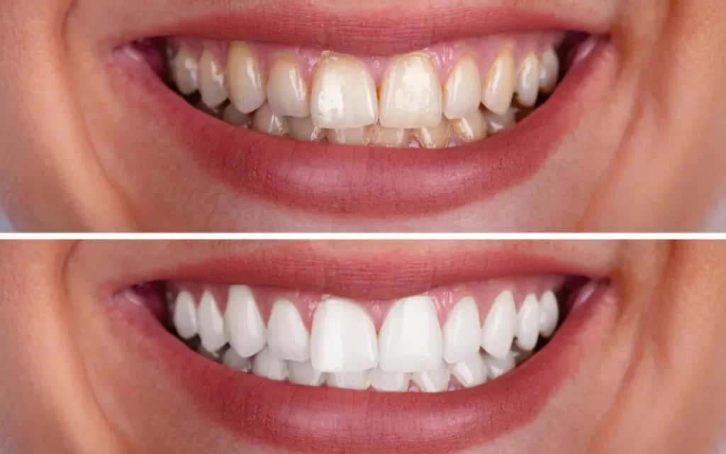 How Much Does Teeth Whitening Cost