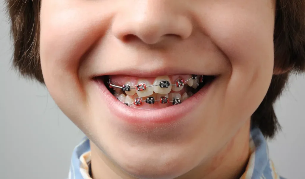 What Age Do Kids Get Braces