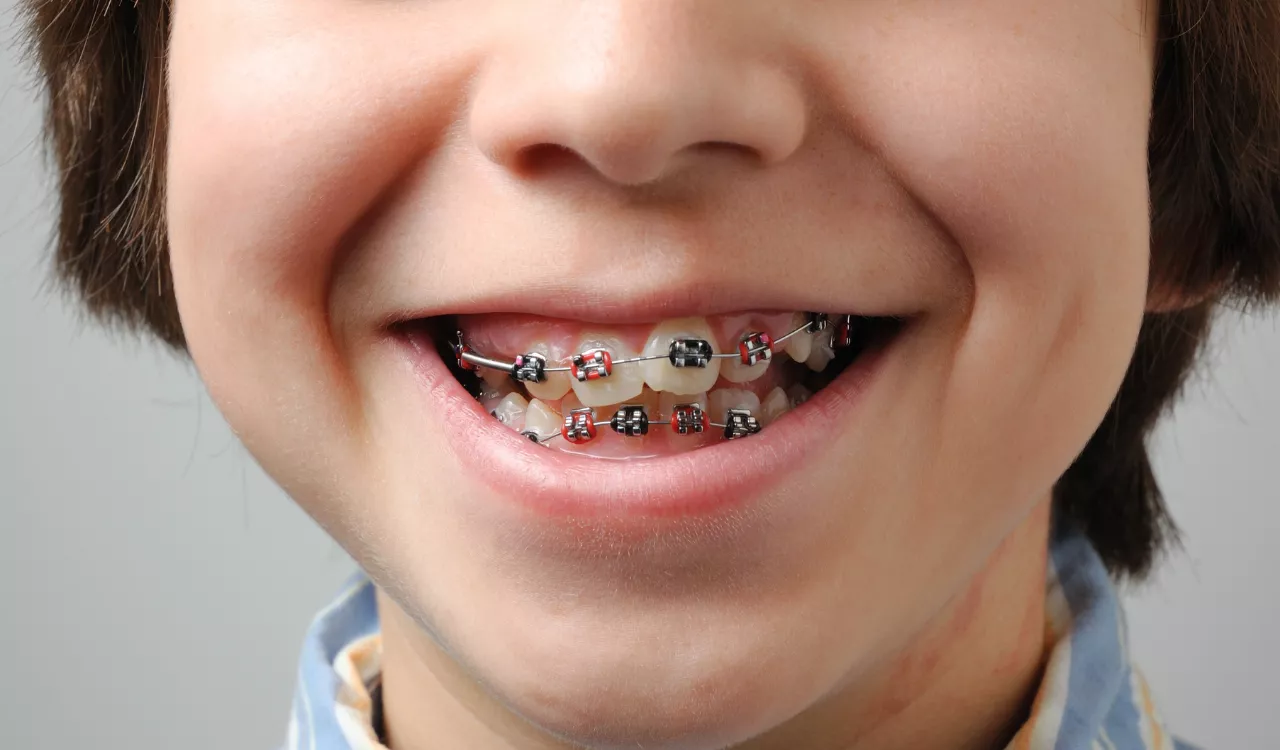 What Age Do Kids Get Braces