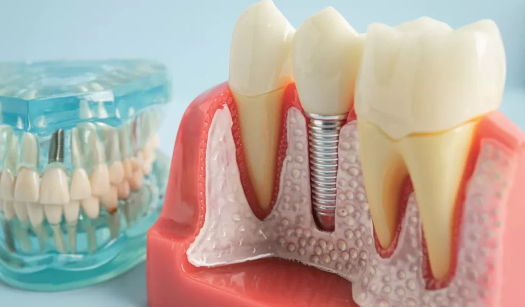 What Happens If I Don't Get a Root Canal