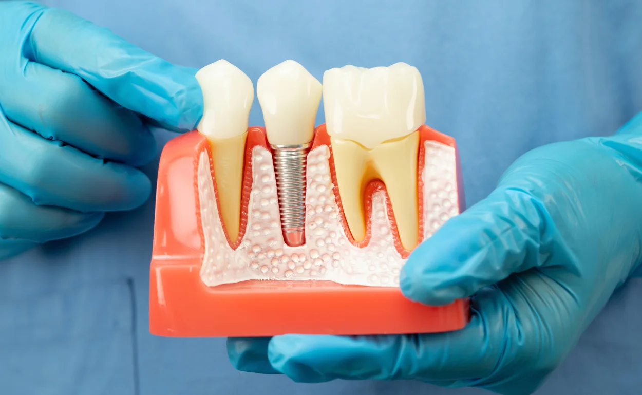 Dental implant model showing implant screw in jawbone - Gentle Dental of NJ Newark