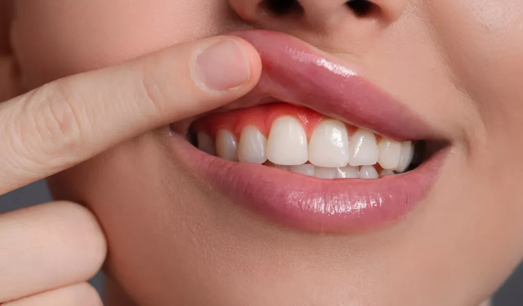 Can I Get Invisalign If I Have Gum Disease